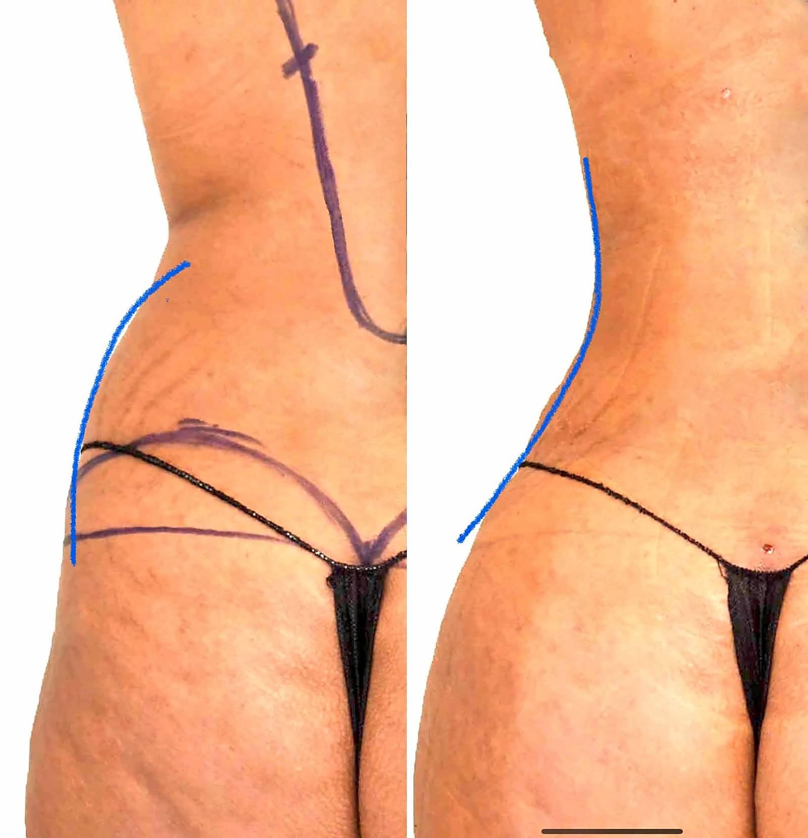 Fat Transfer, BBL before and after, actual patient of Dr. Long