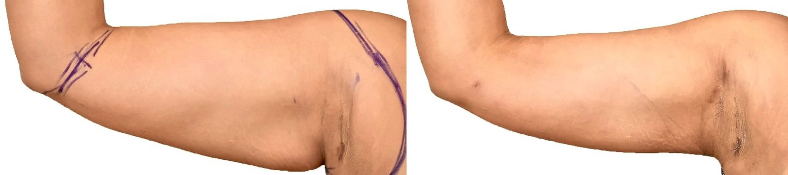 Arm liposuction before and after, actual patient of Dr. Long