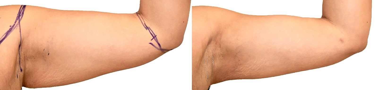 Arm liposuction before and after, actual patient of Dr. Long