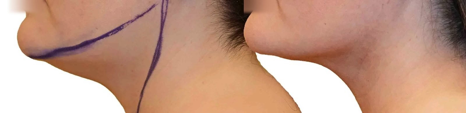 Chin and neck liposuction before and after, actual patient of Dr. Long