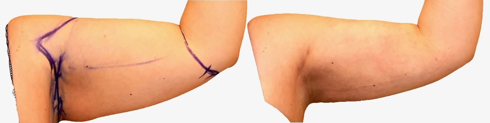 Arm liposuction before and after, actual patient of Dr. Long