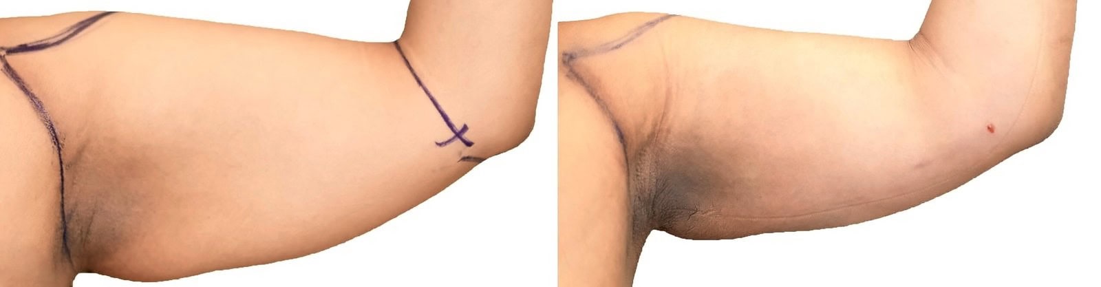 Arm liposuction before and after, actual patient of Dr. Long