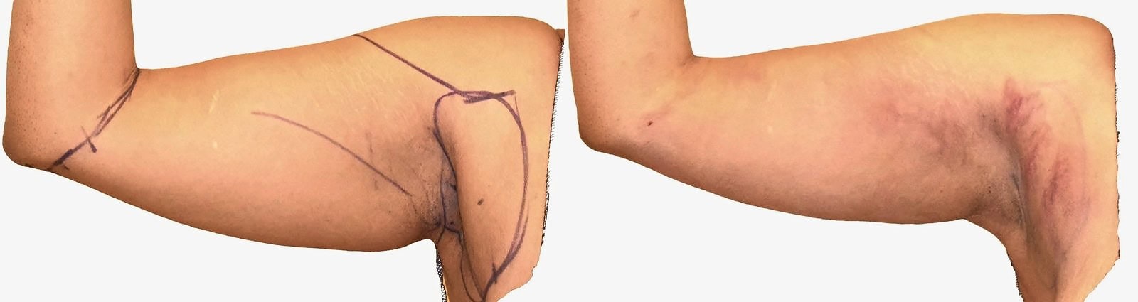 Arm liposuction before and after, actual patient of Dr. Long