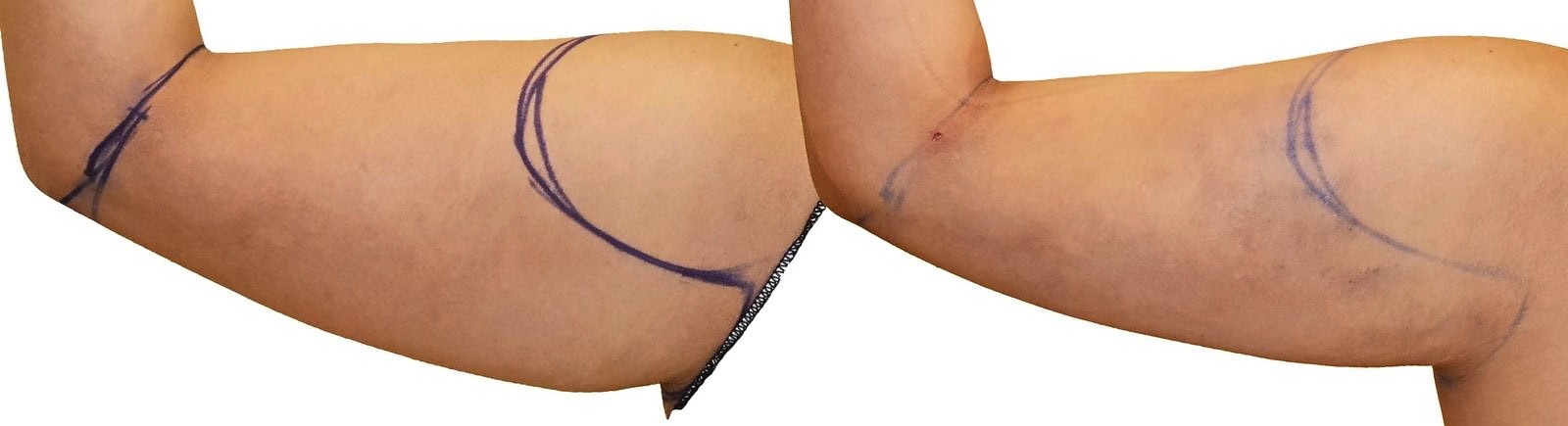 Arm liposuction before and after, actual patient of Dr. Long