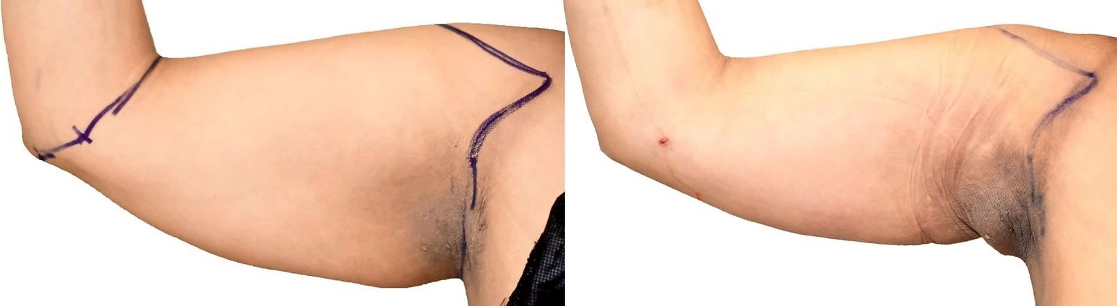 Arm liposuction before and after, actual patient of Dr. Long