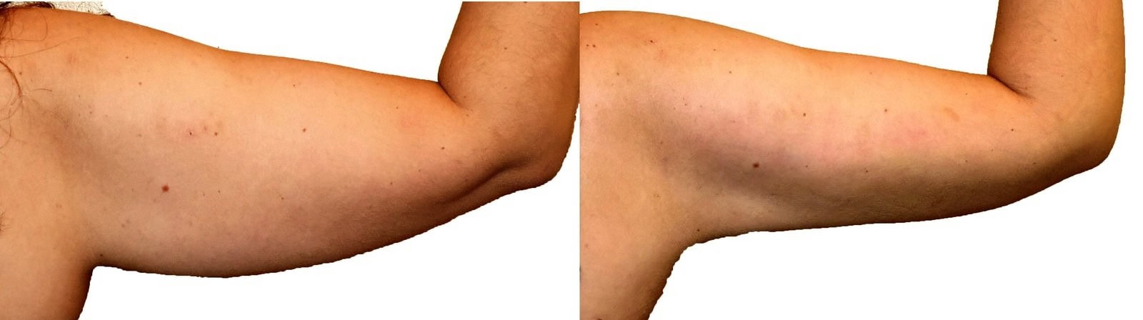Arm liposuction before and after, actual patient of Dr. Long