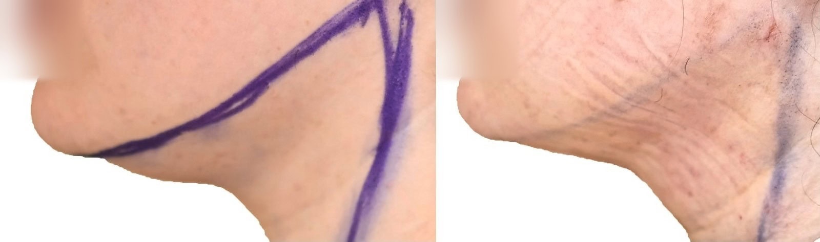 Chin and neck liposuction before and after, actual patient of Dr. Long