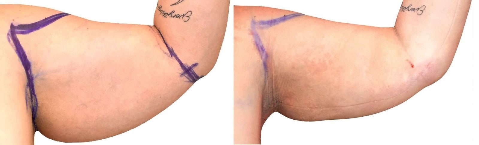 Arm liposuction before and after, actual patient of Dr. Long
