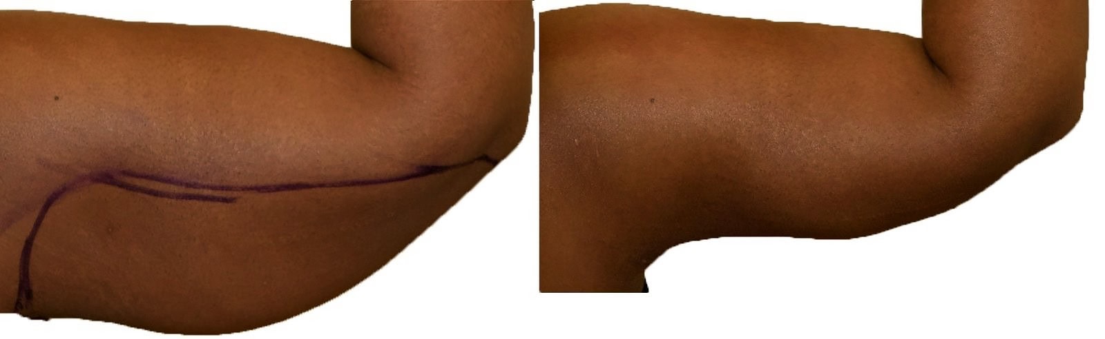 Arm liposuction before and after, actual patient of Dr. Long