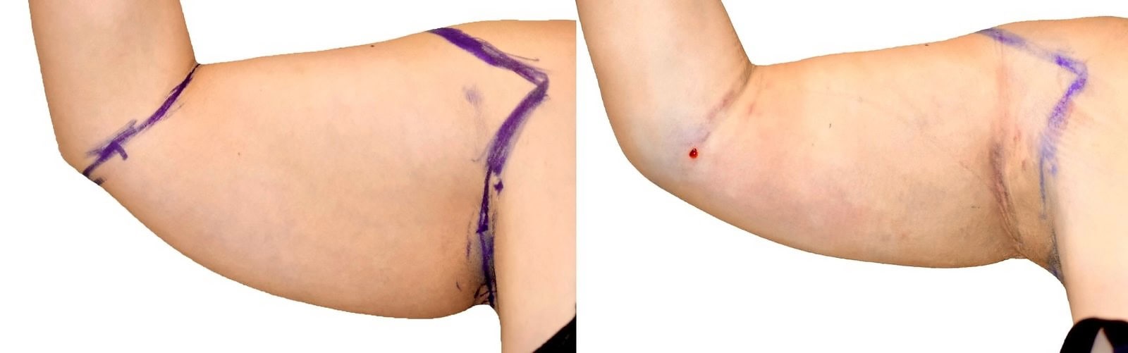Arm liposuction before and after, actual patient of Dr. Long