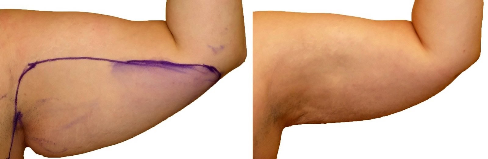 Arm liposuction before and after, actual patient of Dr. Long