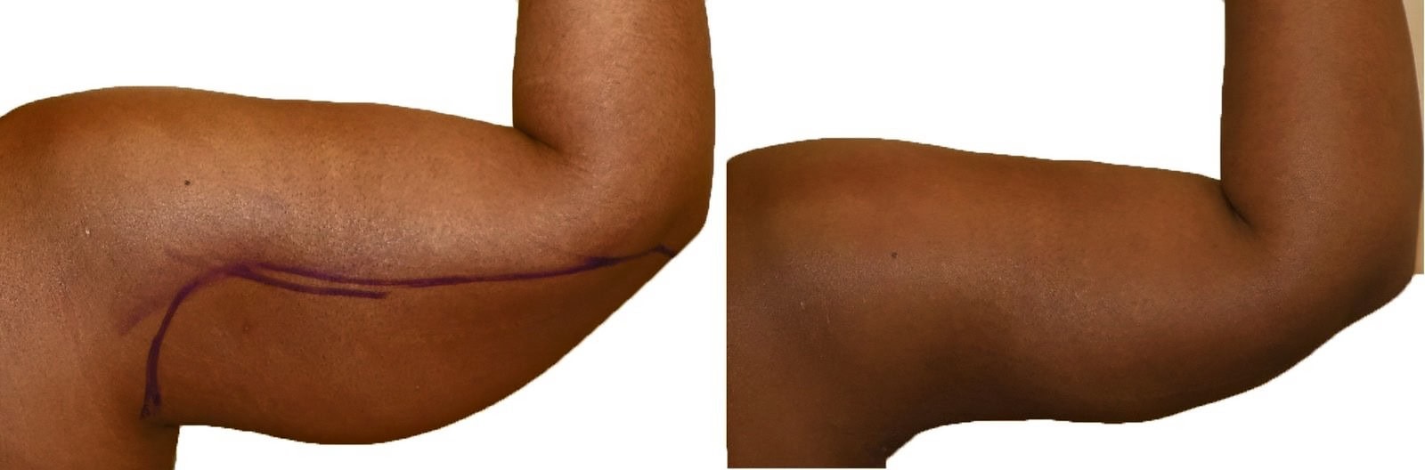 Arm liposuction before and after, actual patient of Dr. Long