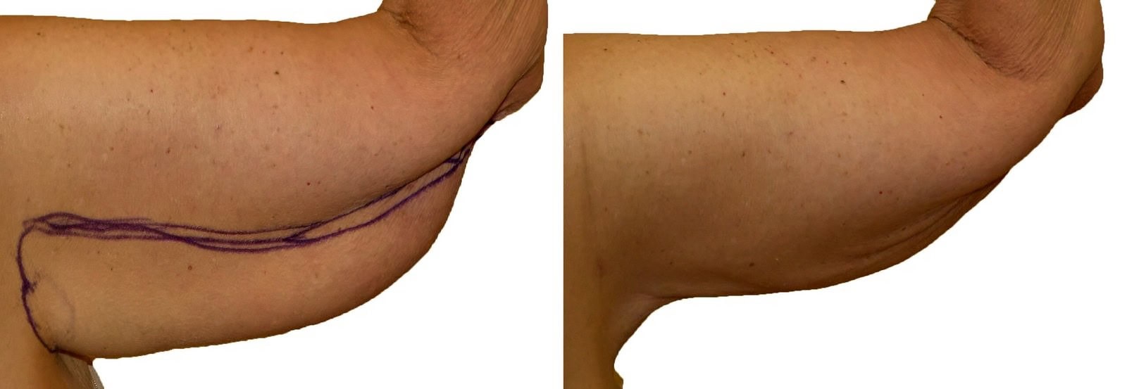 Arm liposuction before and after, actual patient of Dr. Long