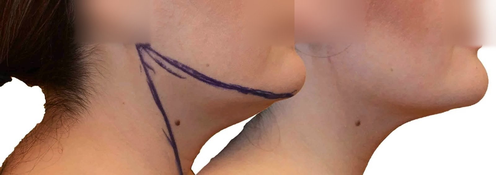 Chin and neck liposuction before and after, actual patient of Dr. Long
