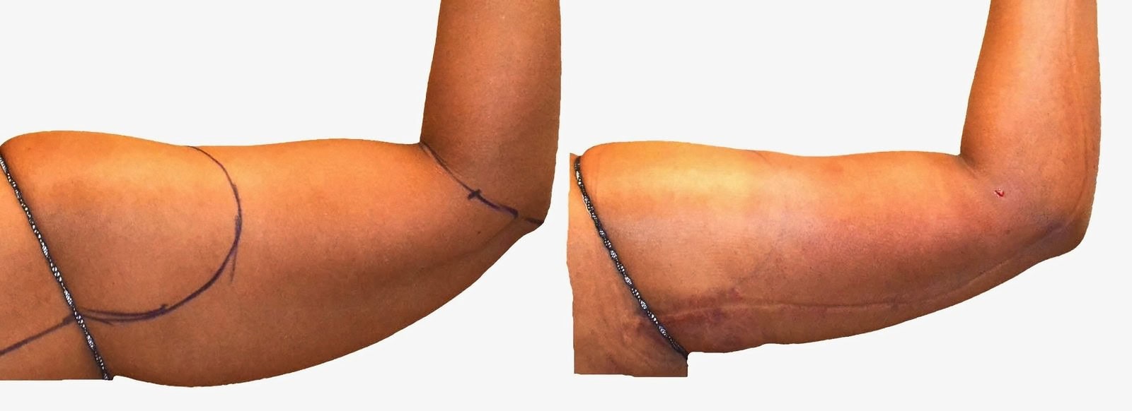 Arm liposuction before and after, actual patient of Dr. Long