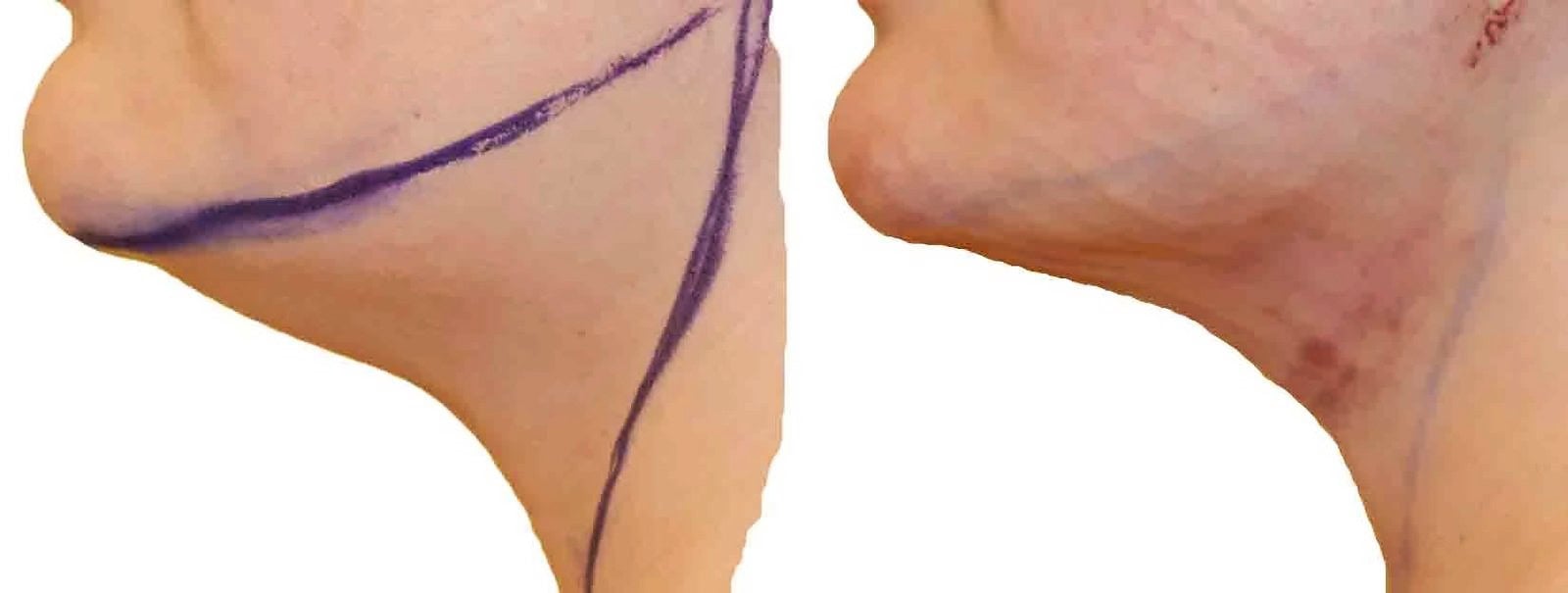 Chin and neck liposuction before and after, actual patient of Dr. Long