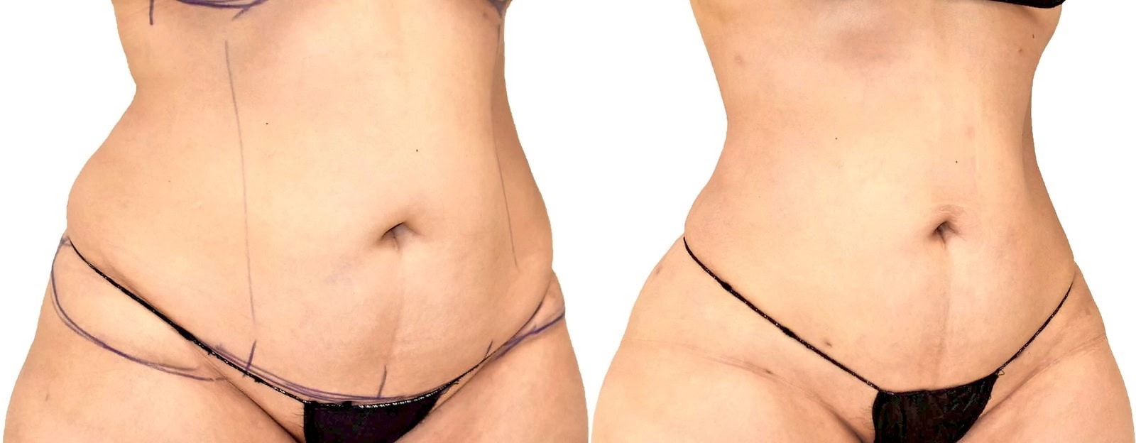 Lipo 360 before and after, actual patient of Dr. Long