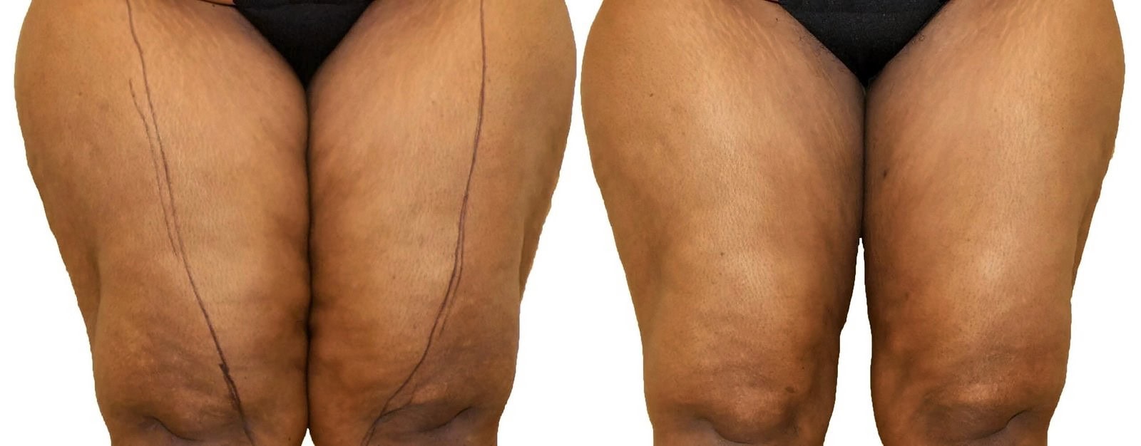 Thigh liposuction before and after, actual patient of Dr. Long