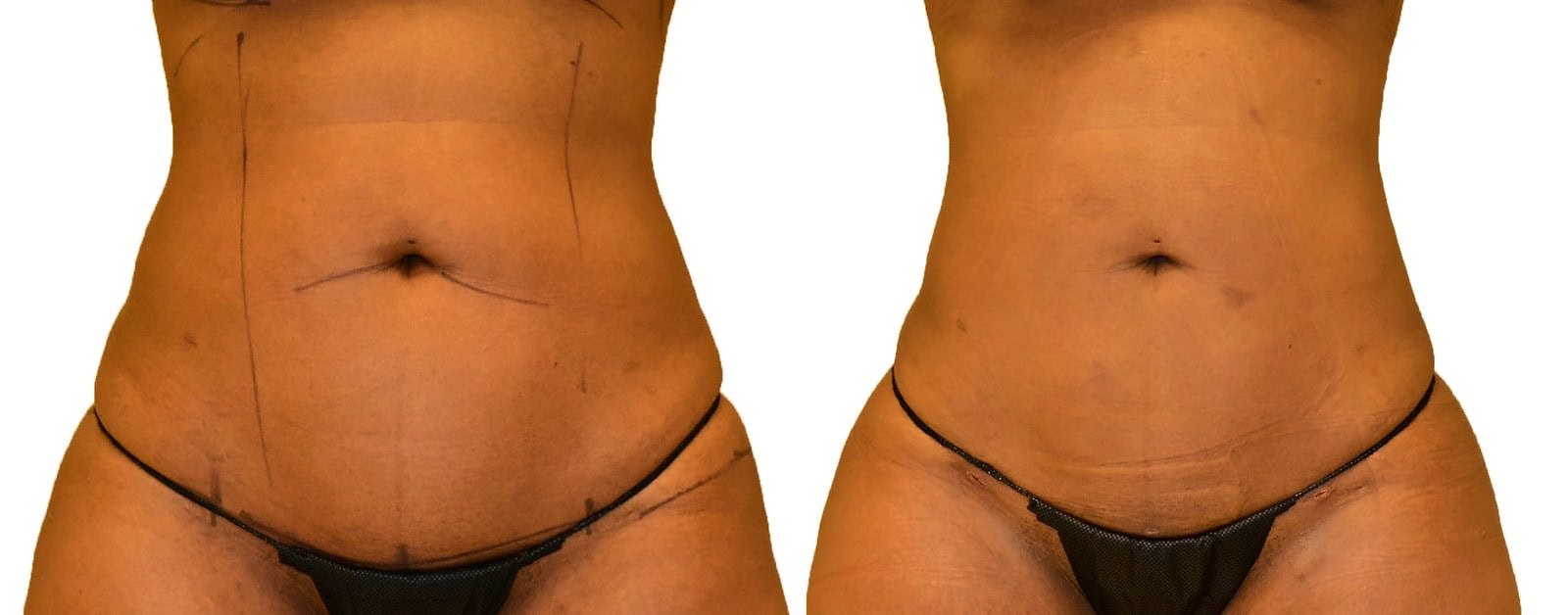 Lipo 360 before and after, actual patient of Dr. Long