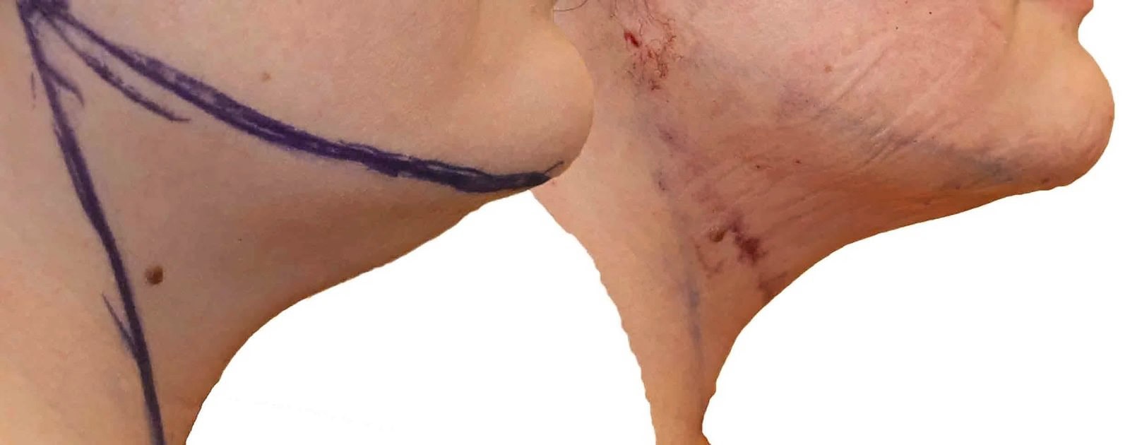 Chin and neck liposuction before and after, actual patient of Dr. Long