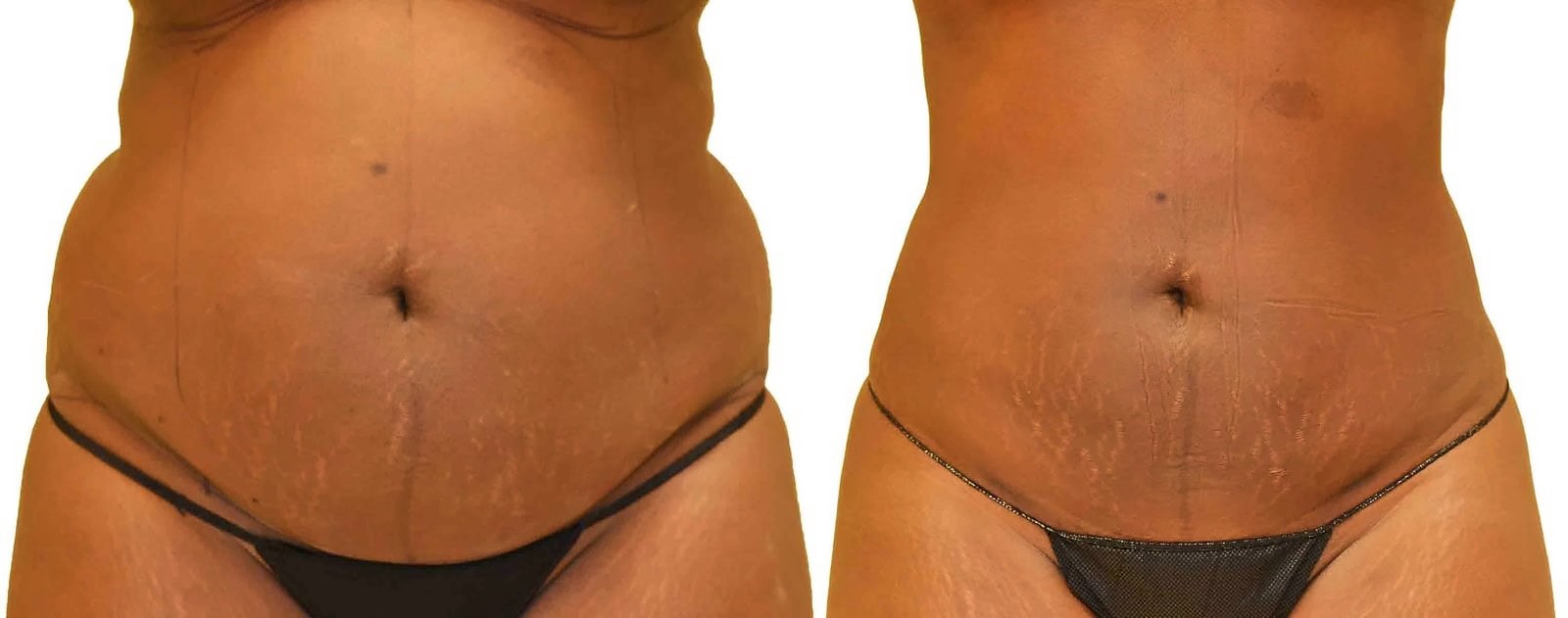 Lipo 360 before and after, actual patient of Dr. Long