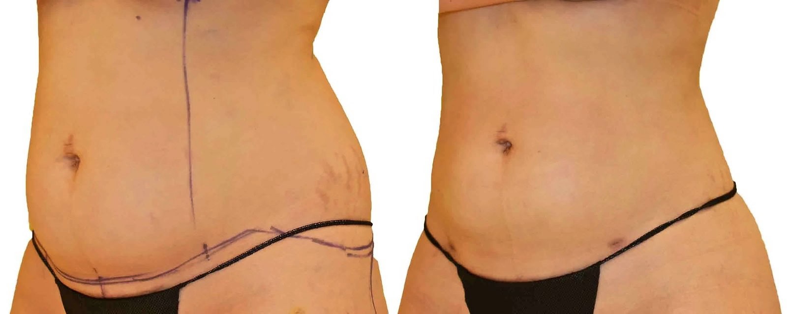 Lipo 360 before and after, actual patient of Dr. Long