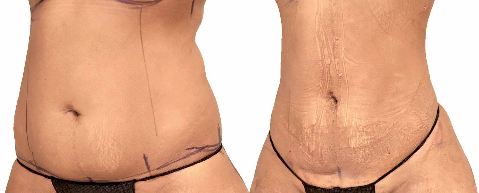 Lipo 360 before and after, actual patient of Dr. Long
