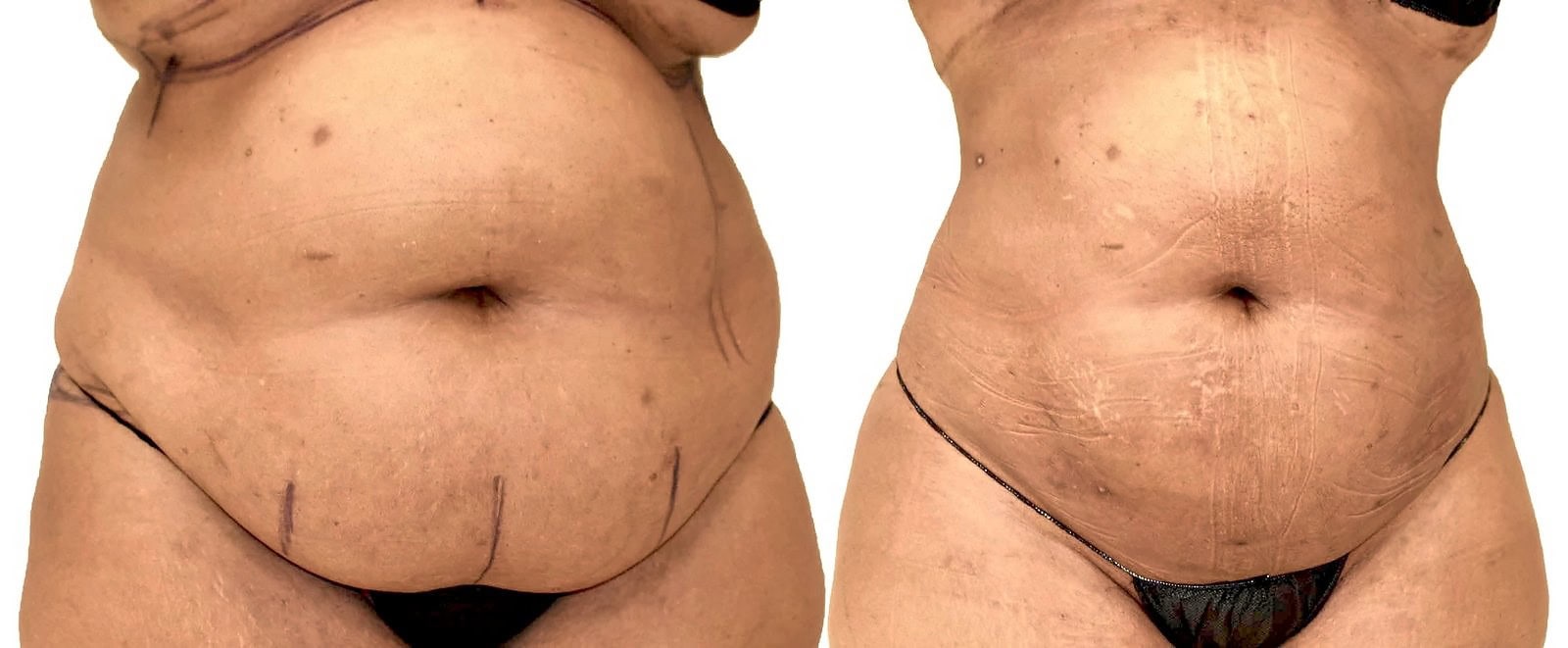 Lipo 360 before and after, actual patient of Dr. Long