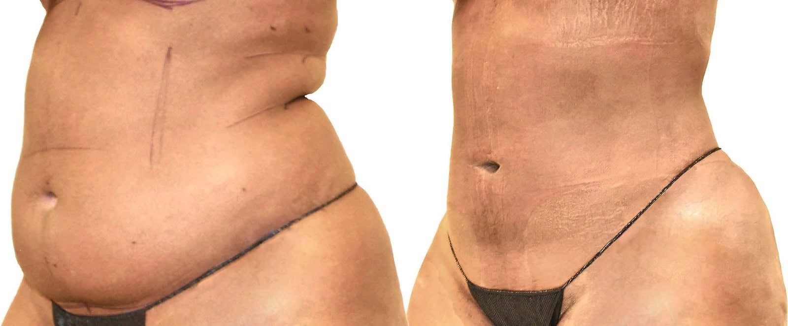 Lipo 360 before and after, actual patient of Dr. Long