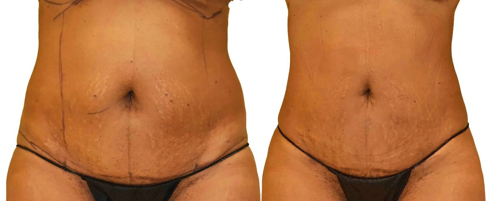 Lipo 360 before and after, actual patient of Dr. Long