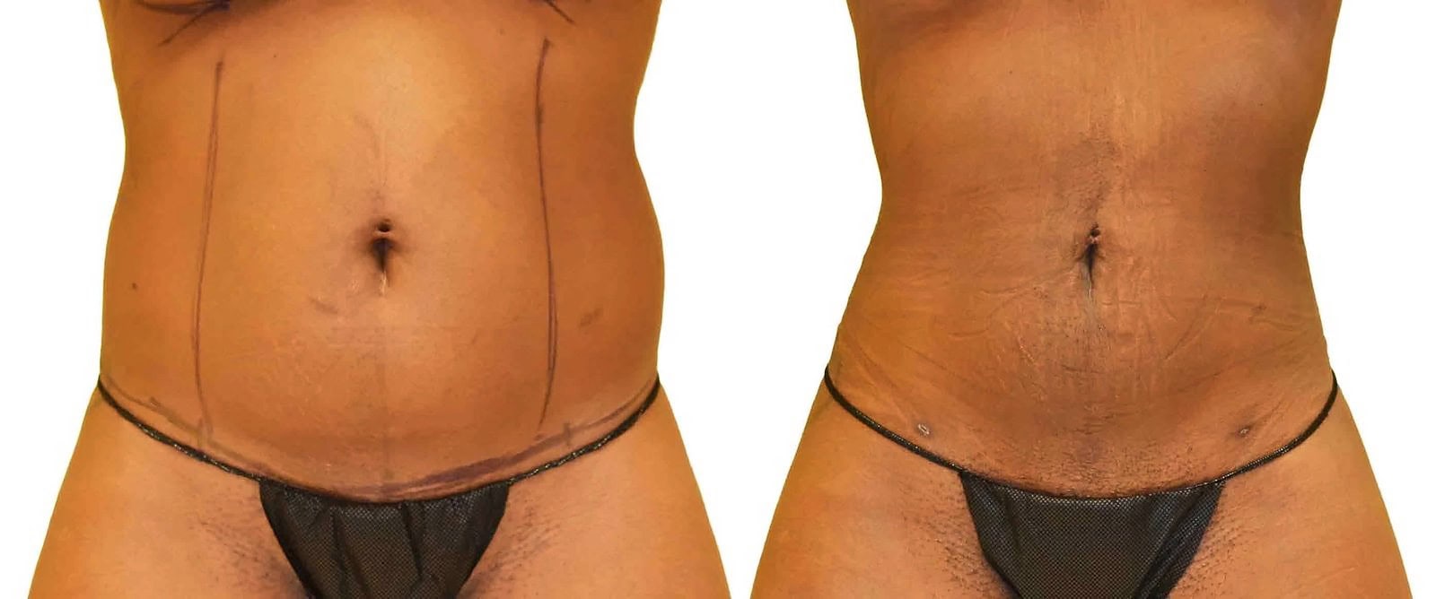 Lipo 360 before and after, actual patient of Dr. Long