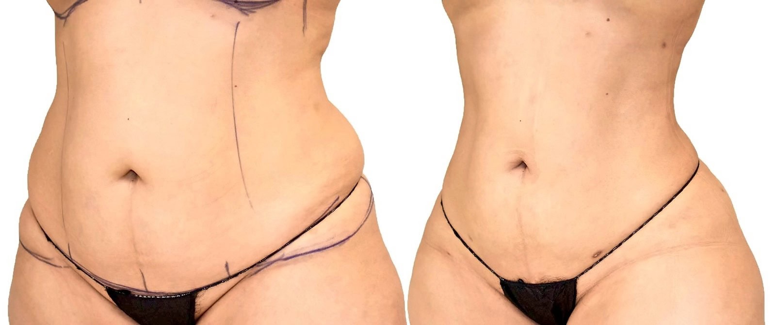 Lipo 360 before and after, actual patient of Dr. Long