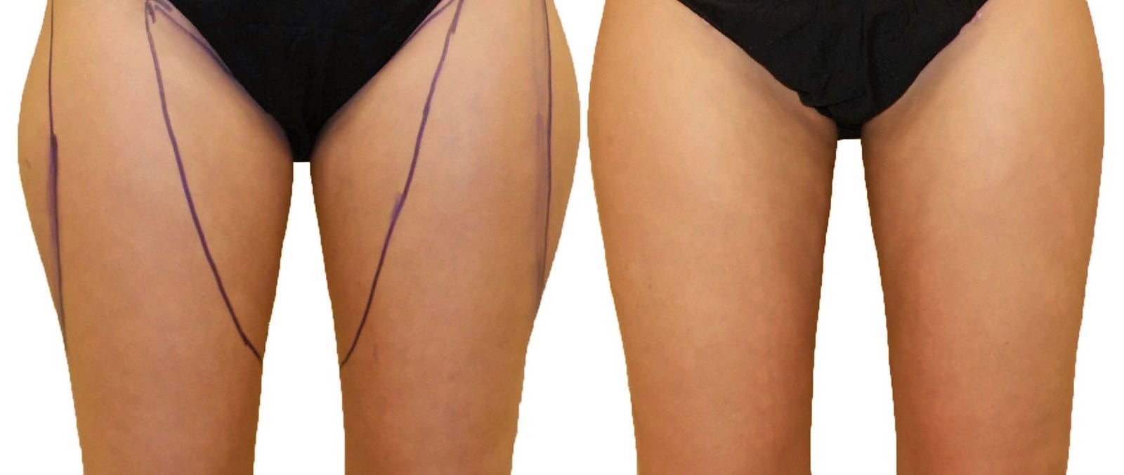 Thigh liposuction before and after, actual patient of Dr. Long
