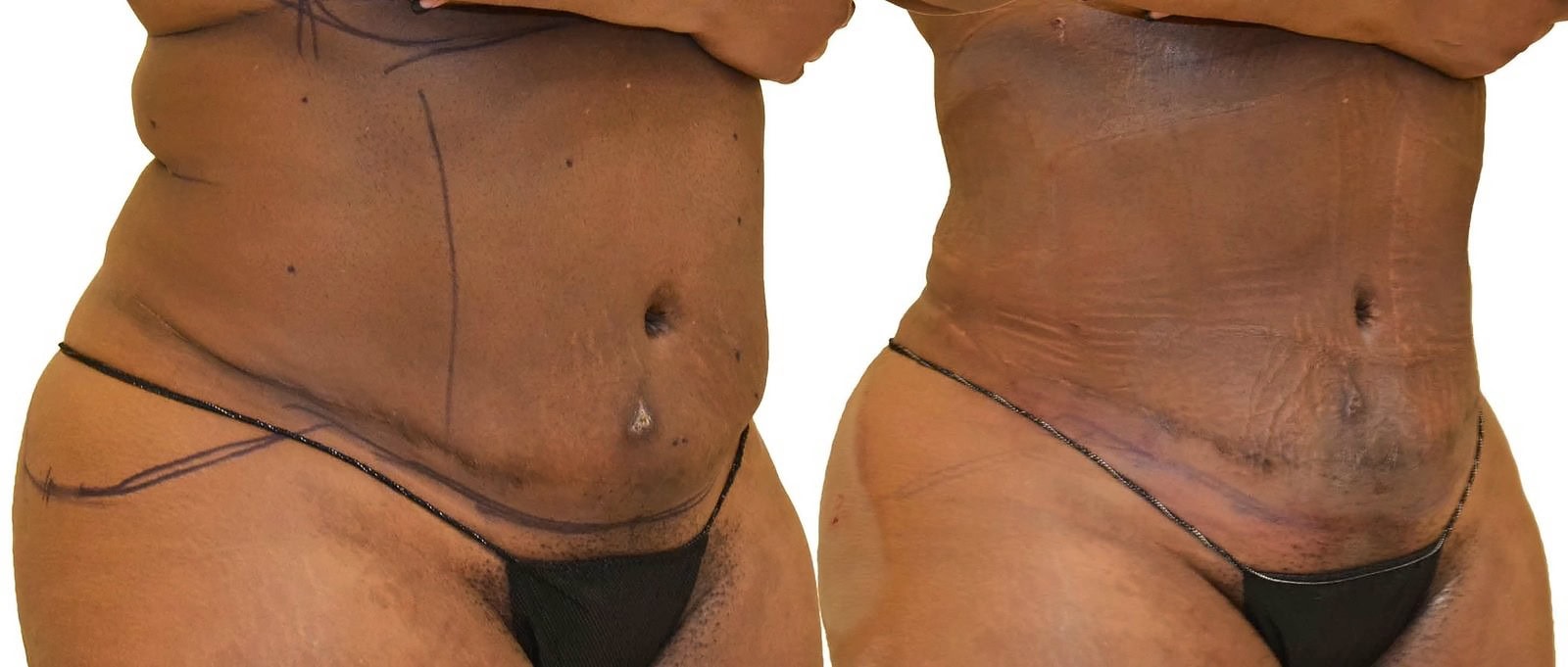 Lipo 360 before and after, actual patient of Dr. Long