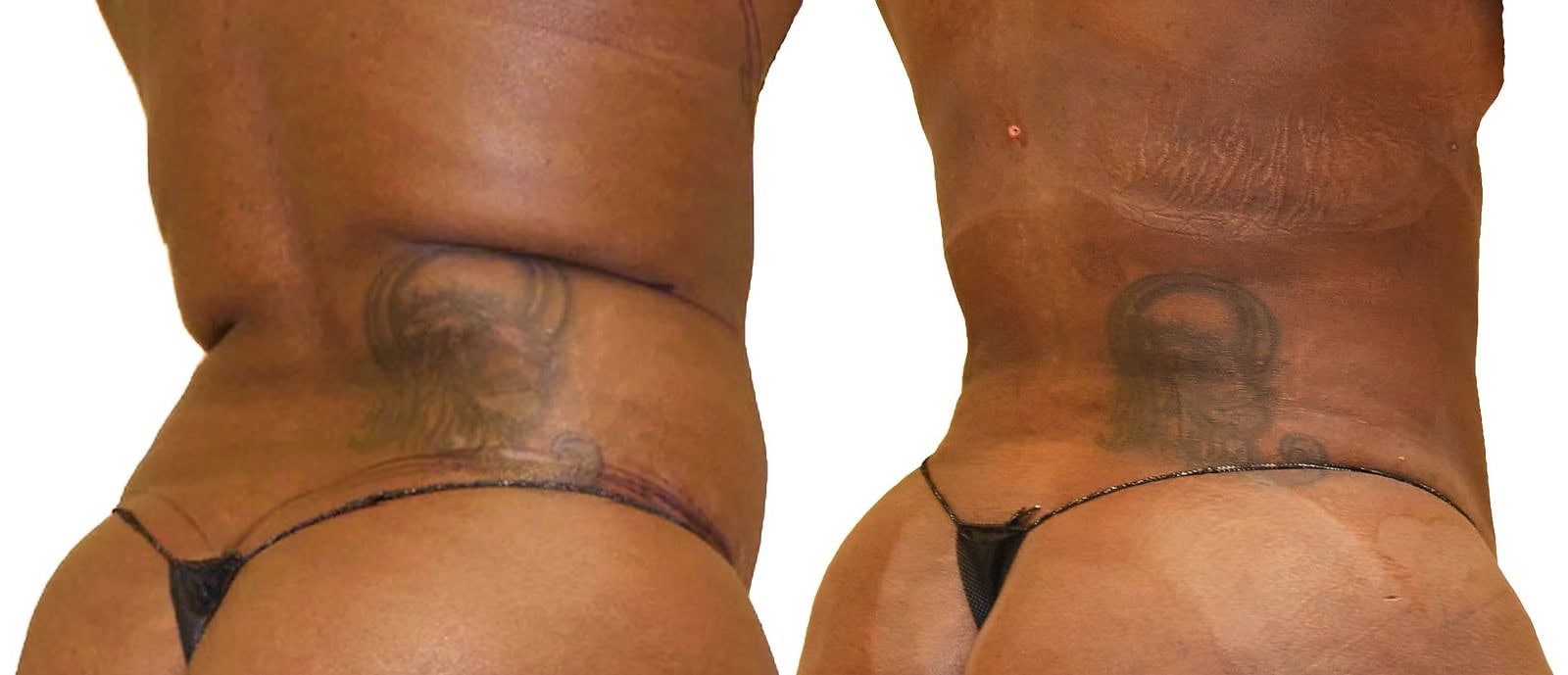 Fat Transfer, BBL before and after, actual patient of Dr. Long