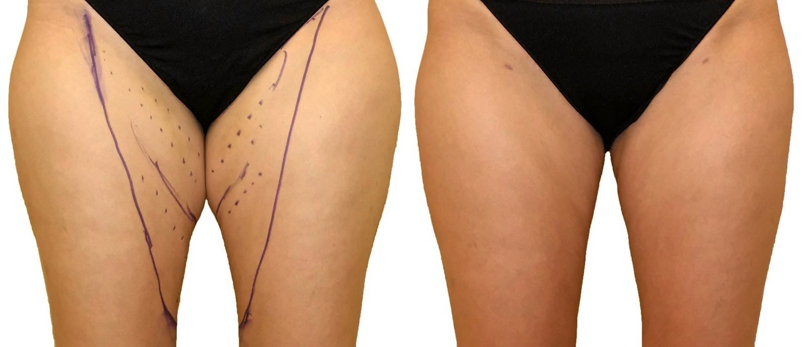 Thigh liposuction before and after, actual patient of Dr. Long