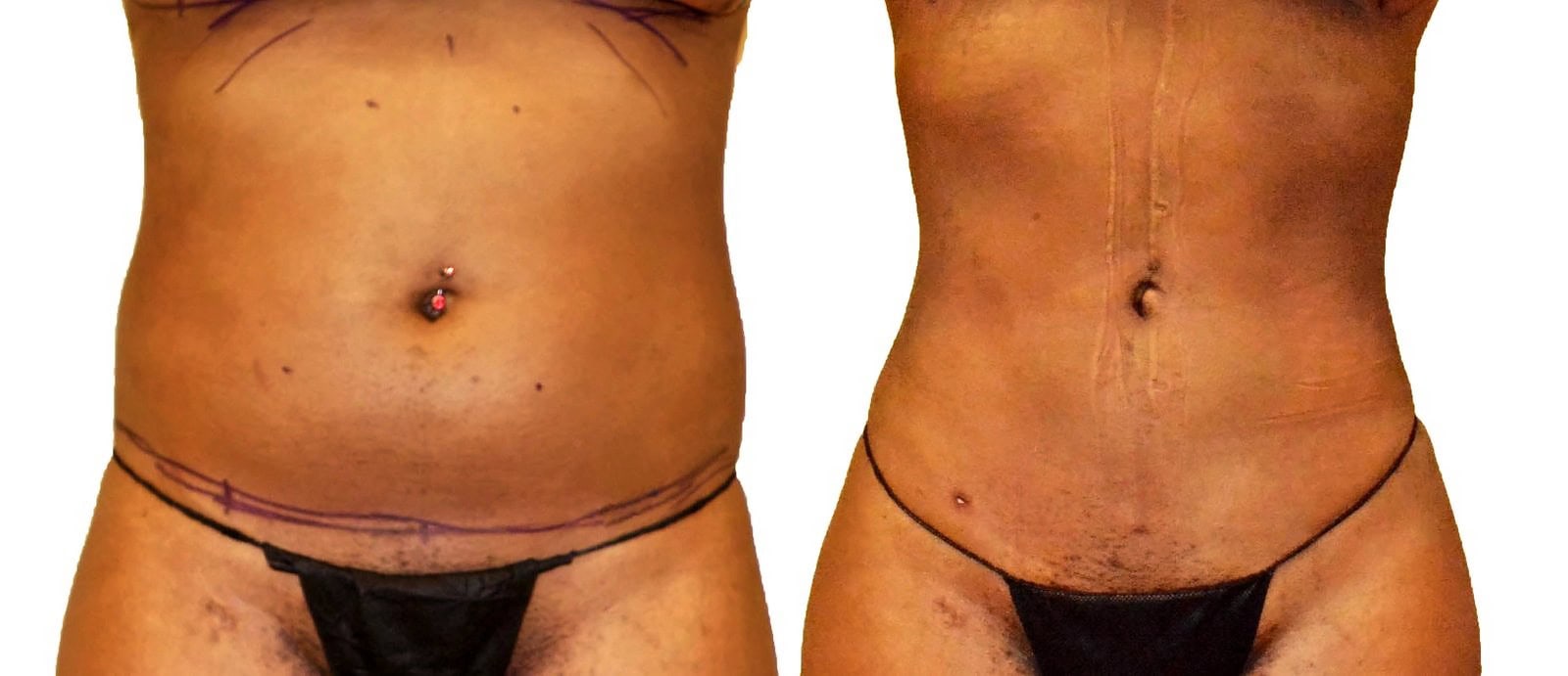 Lipo 360 before and after, actual patient of Dr. Long