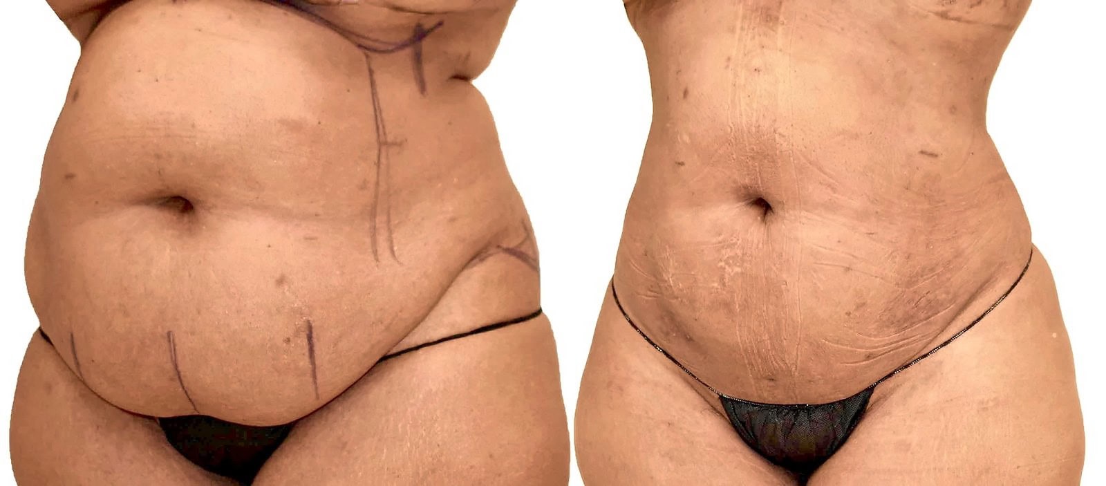 Lipo 360 before and after, actual patient of Dr. Long