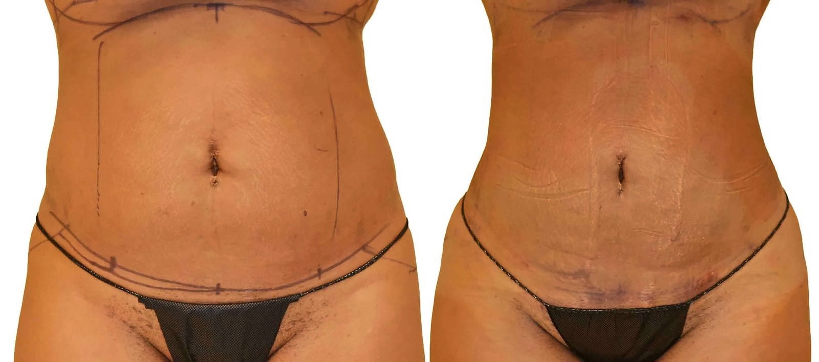 Lipo 360 before and after, actual patient of Dr. Long