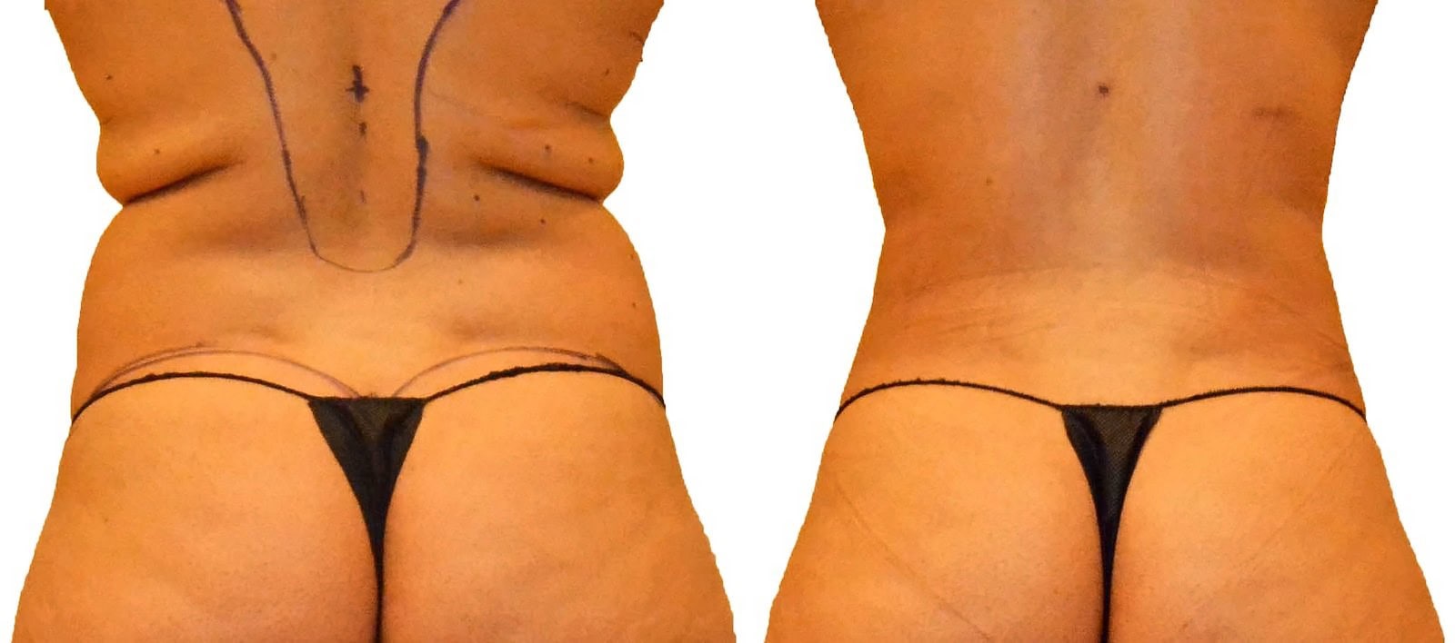 Fat Transfer, BBL before and after, actual patient of Dr. Long
