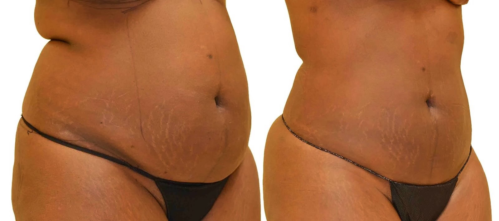 Lipo 360 before and after, actual patient of Dr. Long