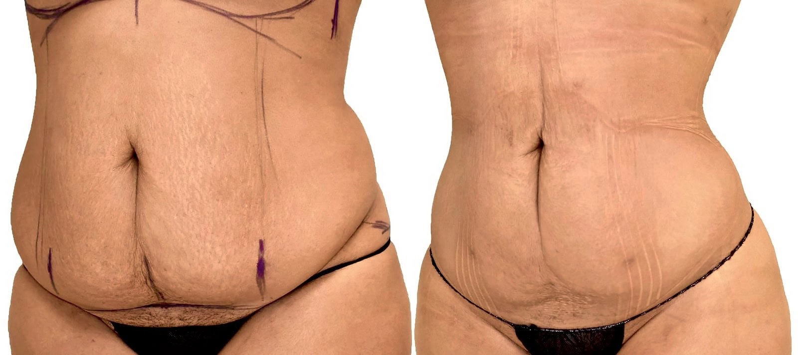 Lipo 360 before and after, actual patient of Dr. Long