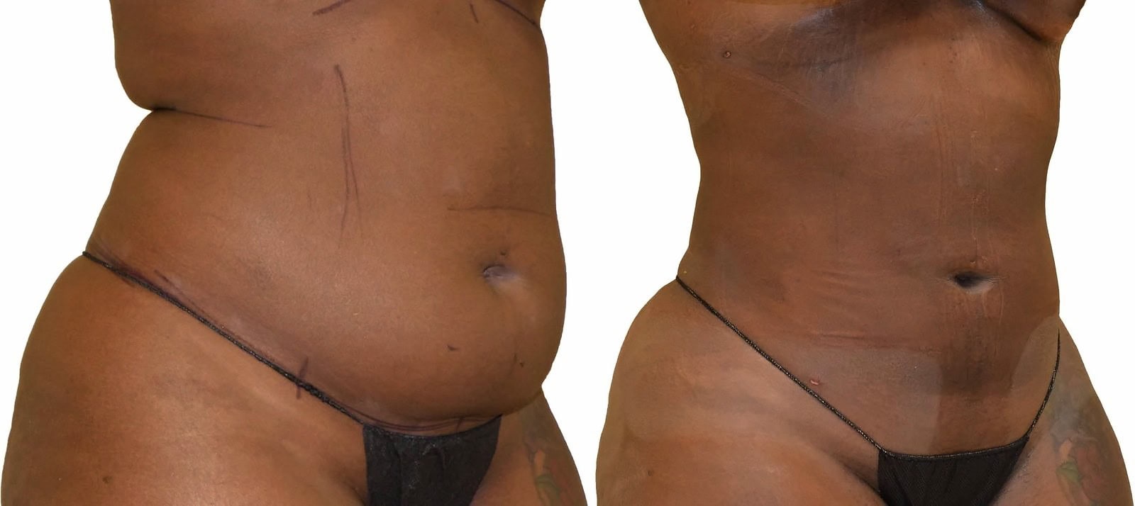 Lipo 360 before and after, actual patient of Dr. Long