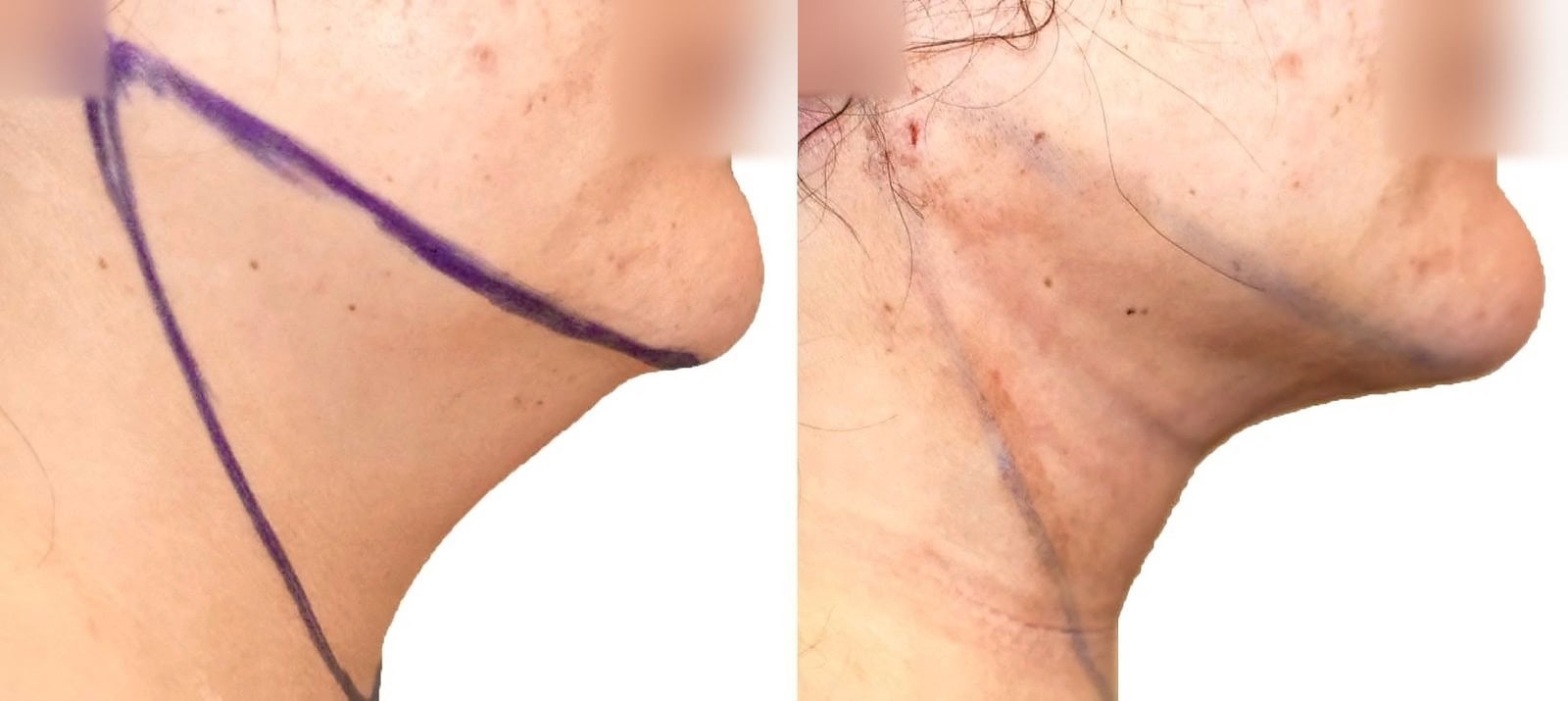 Chin and neck liposuction before and after, actual patient of Dr. Long