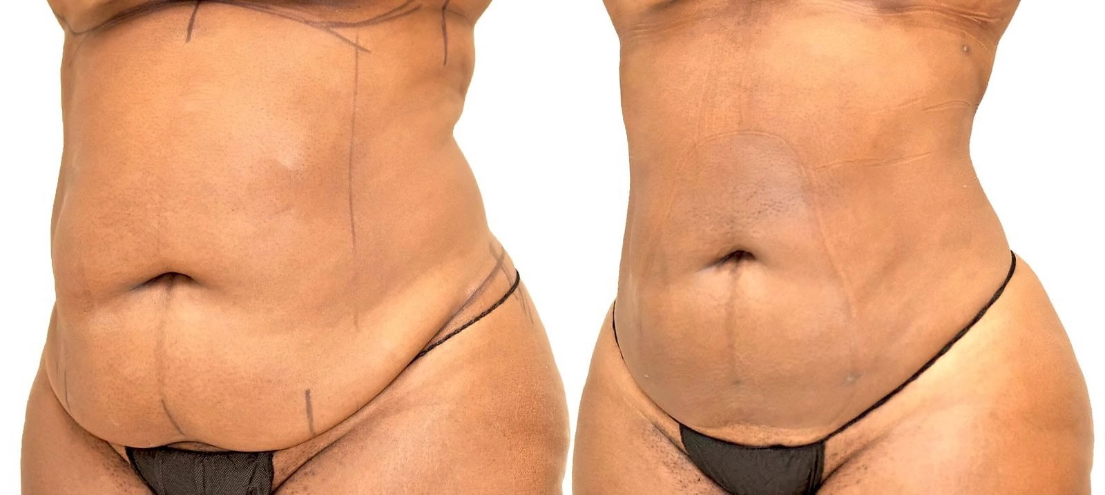 Lipo 360 before and after, actual patient of Dr. Long