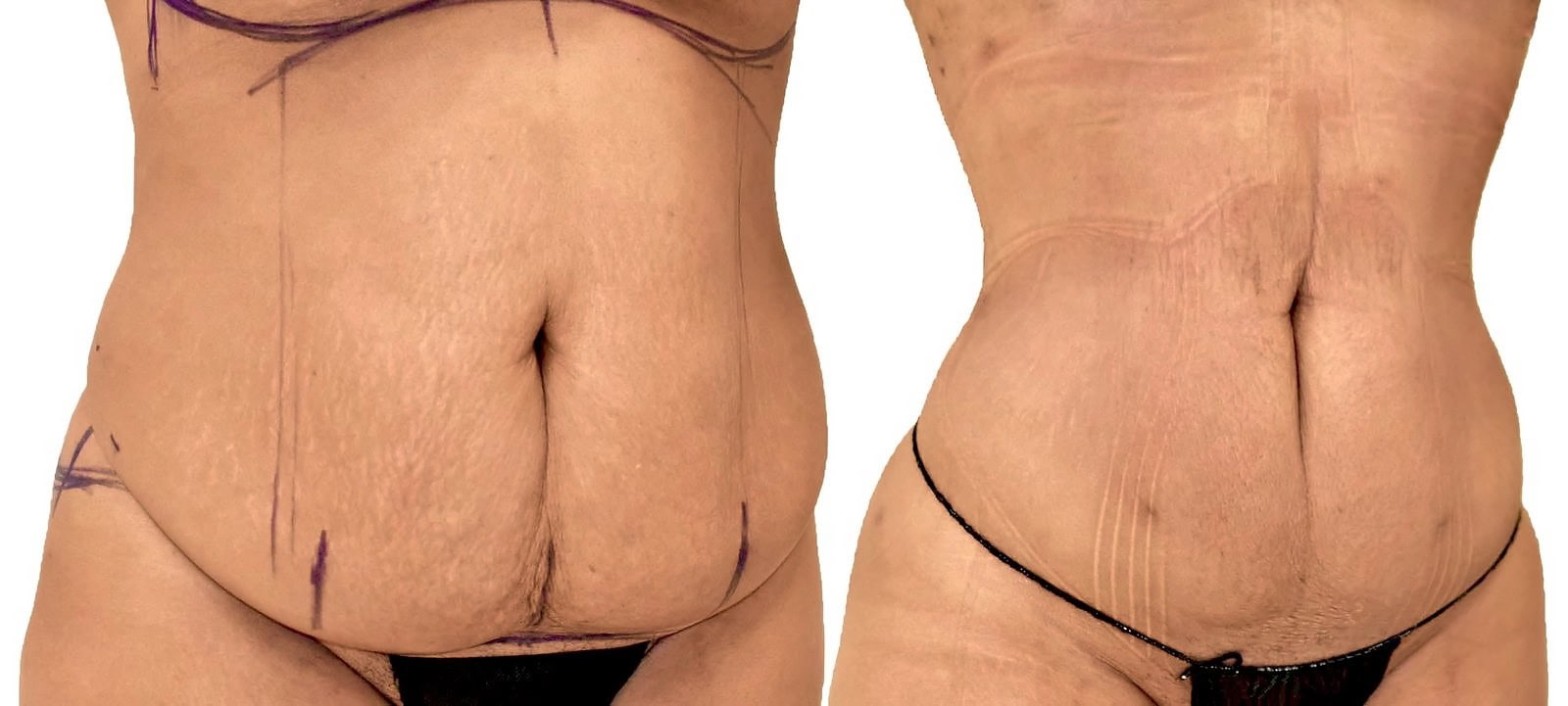 Lipo 360 before and after, actual patient of Dr. Long