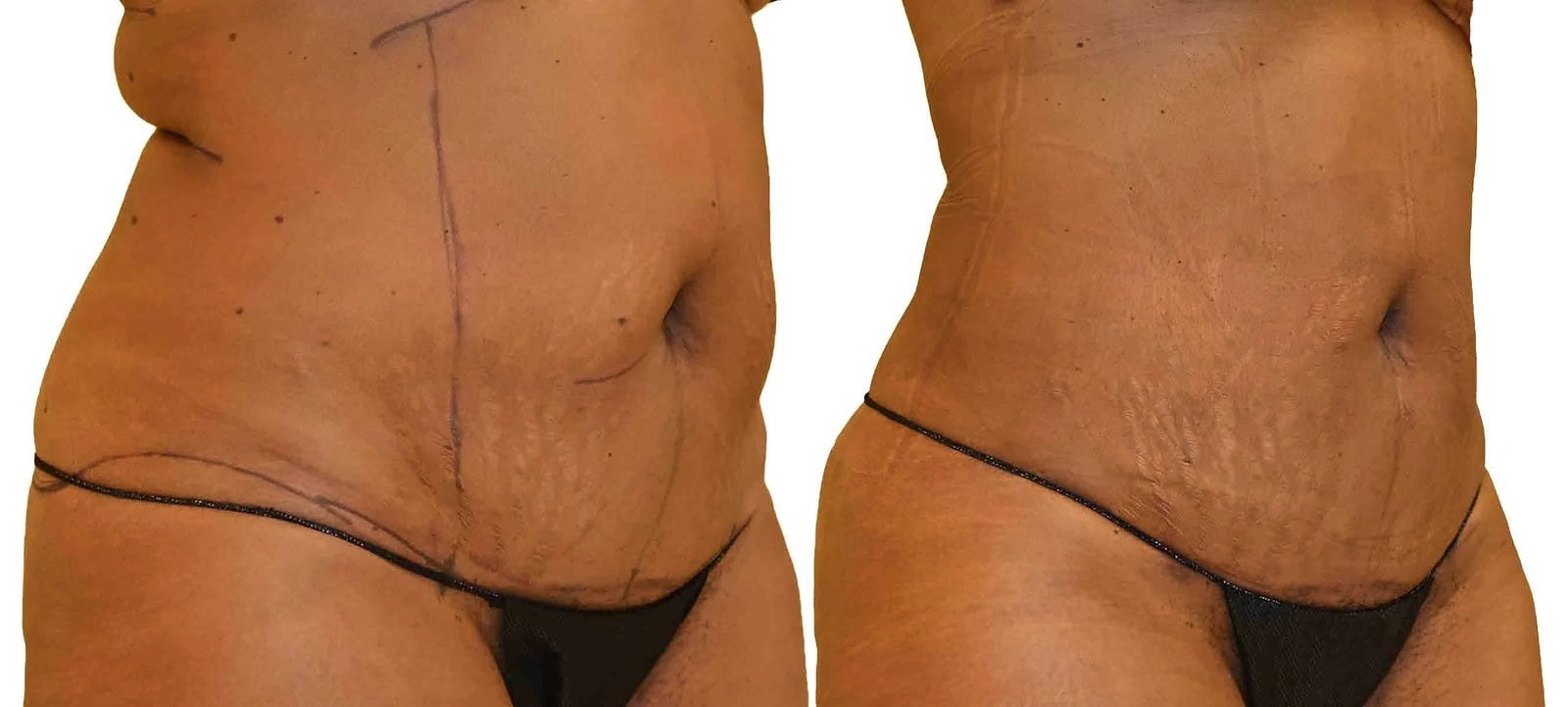 Lipo 360 before and after, actual patient of Dr. Long