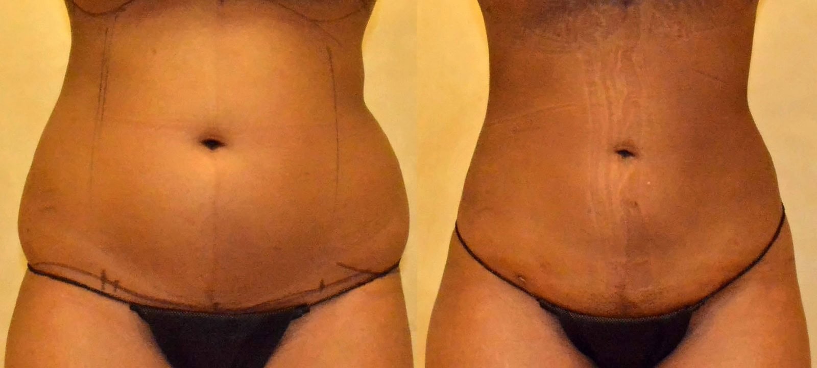 Lipo 360 before and after, actual patient of Dr. Long