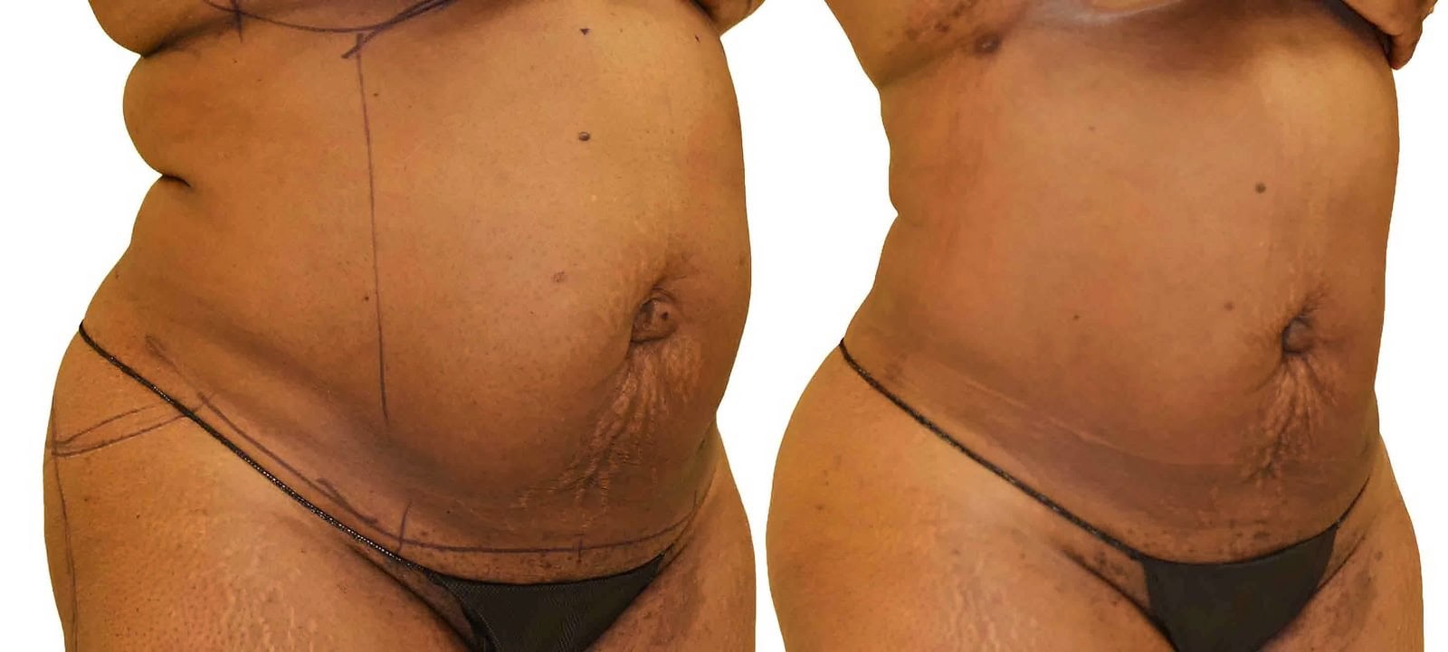Lipo 360 before and after, actual patient of Dr. Long