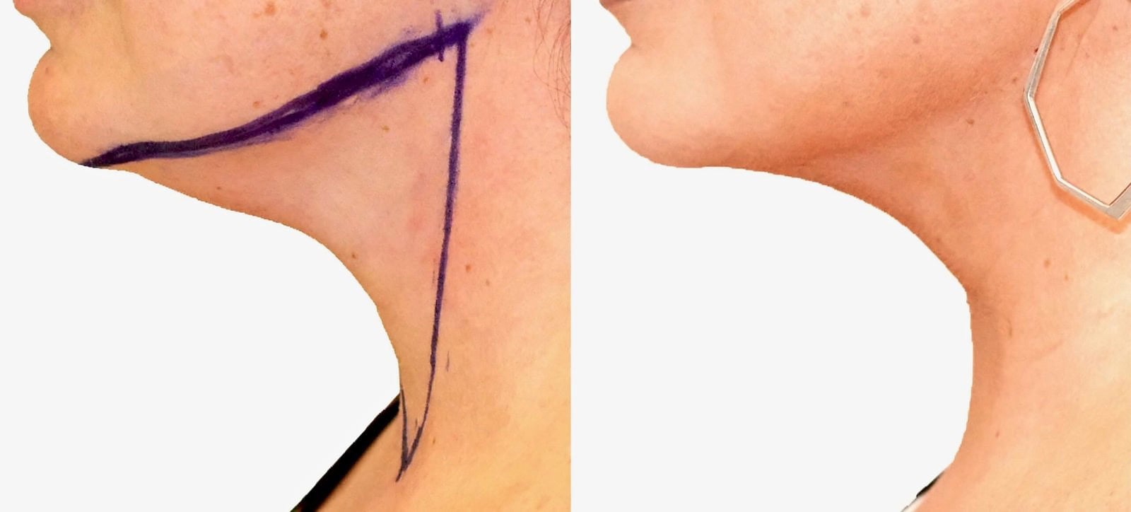 Chin and neck liposuction before and after, actual patient of Dr. Long